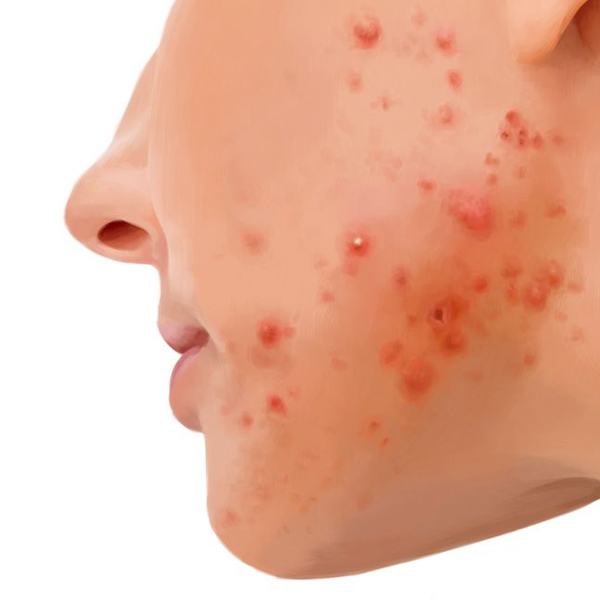 Skin Treatment, Cortisone Cream available in online  pharmacy qatar, doha 