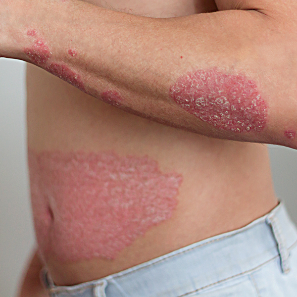 Skin Treatment, Psoriasis available in online  pharmacy qatar, doha 